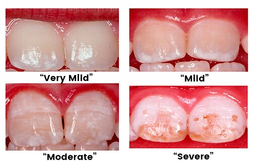 fluorosis