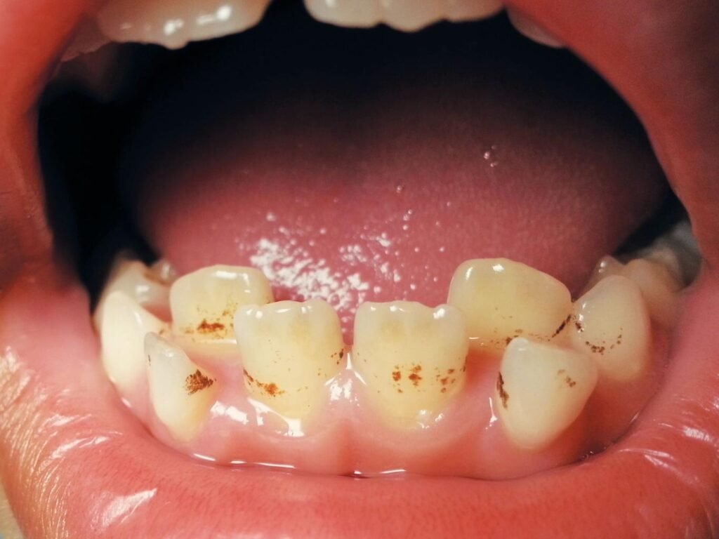 fluorosis