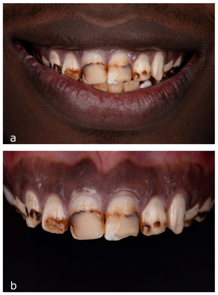 fluorosis
